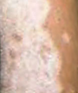 Piel con vitiligo