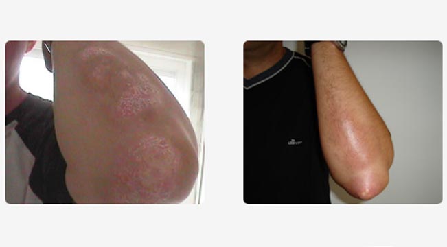 Piel sana recuperada