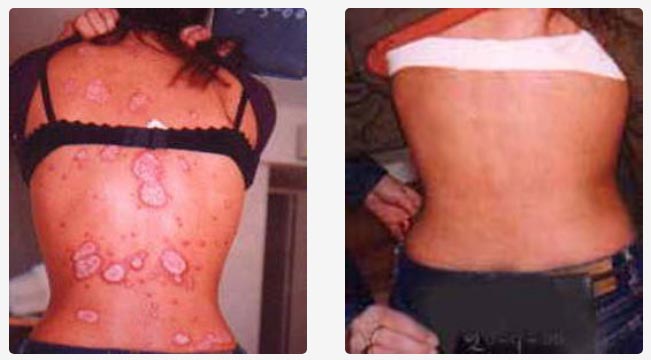 Psoriasis en manos