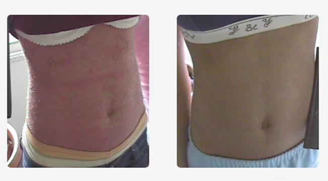 Psoriasis en gota