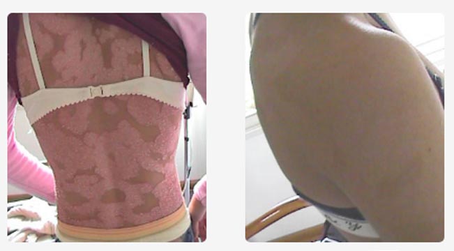 Evolución en piernas