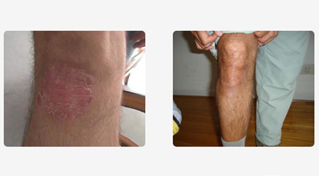 Recuperación de rodillas