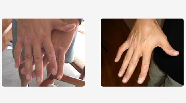 Antes del tratamiento